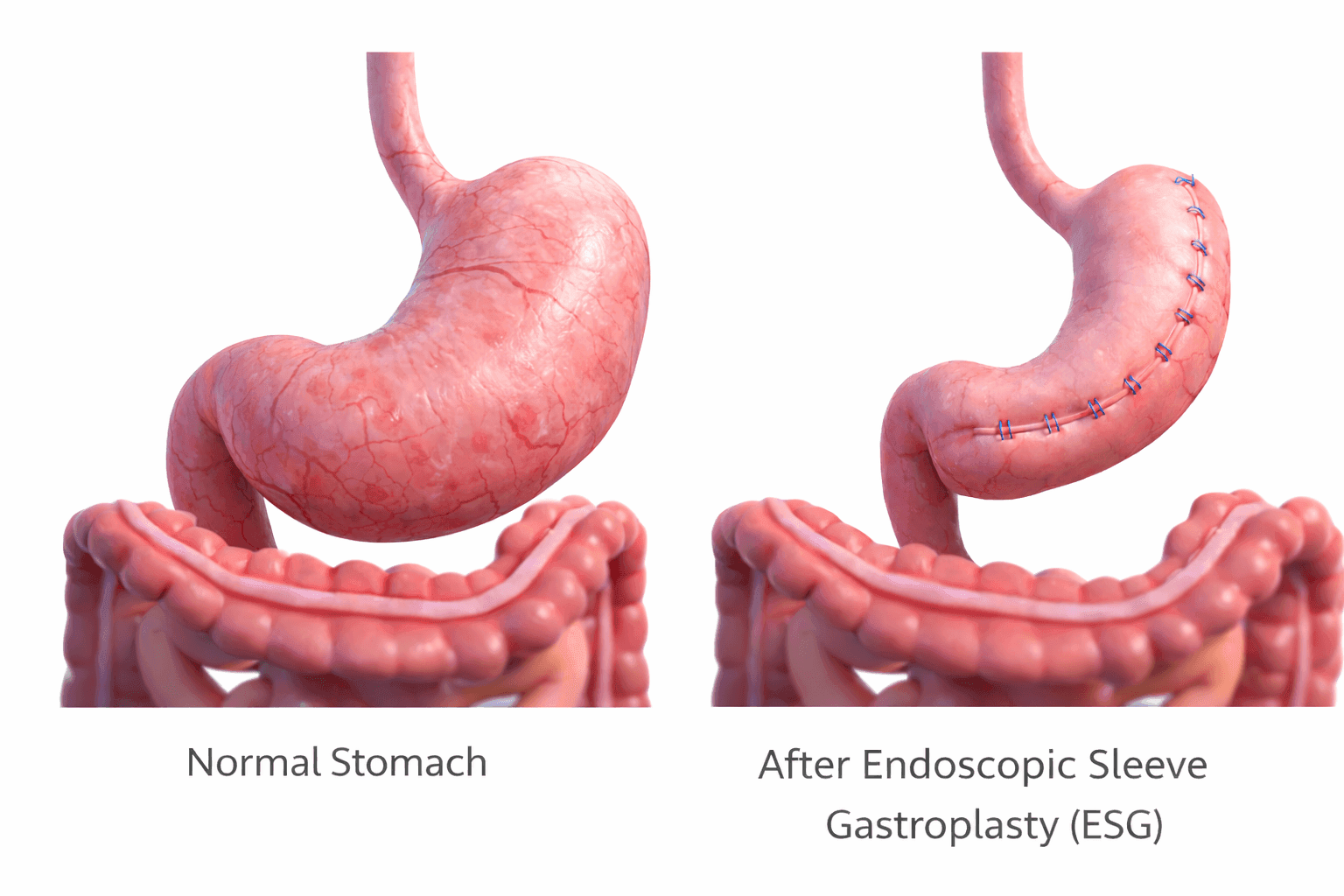 Endoscopic Sleeve Gastroplasty (ESG): Normal stomach vs after ESG procedure
