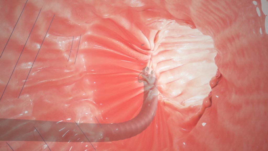 Endoscopic Sleeve Gastroplasty (ESG): A Minimally Invasive Weight Loss Option