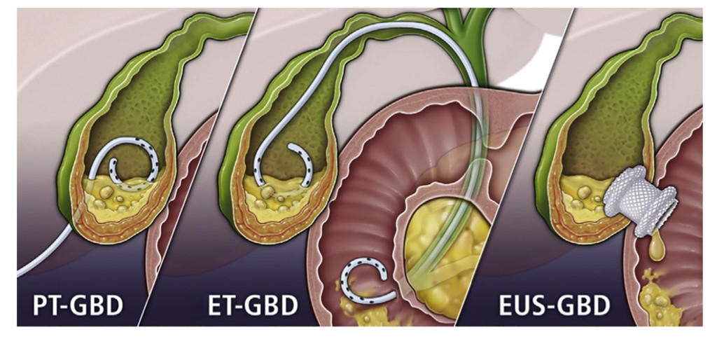 Gallbladder Problems Without Surgery: EUS-Guided Gallbladder Drainage